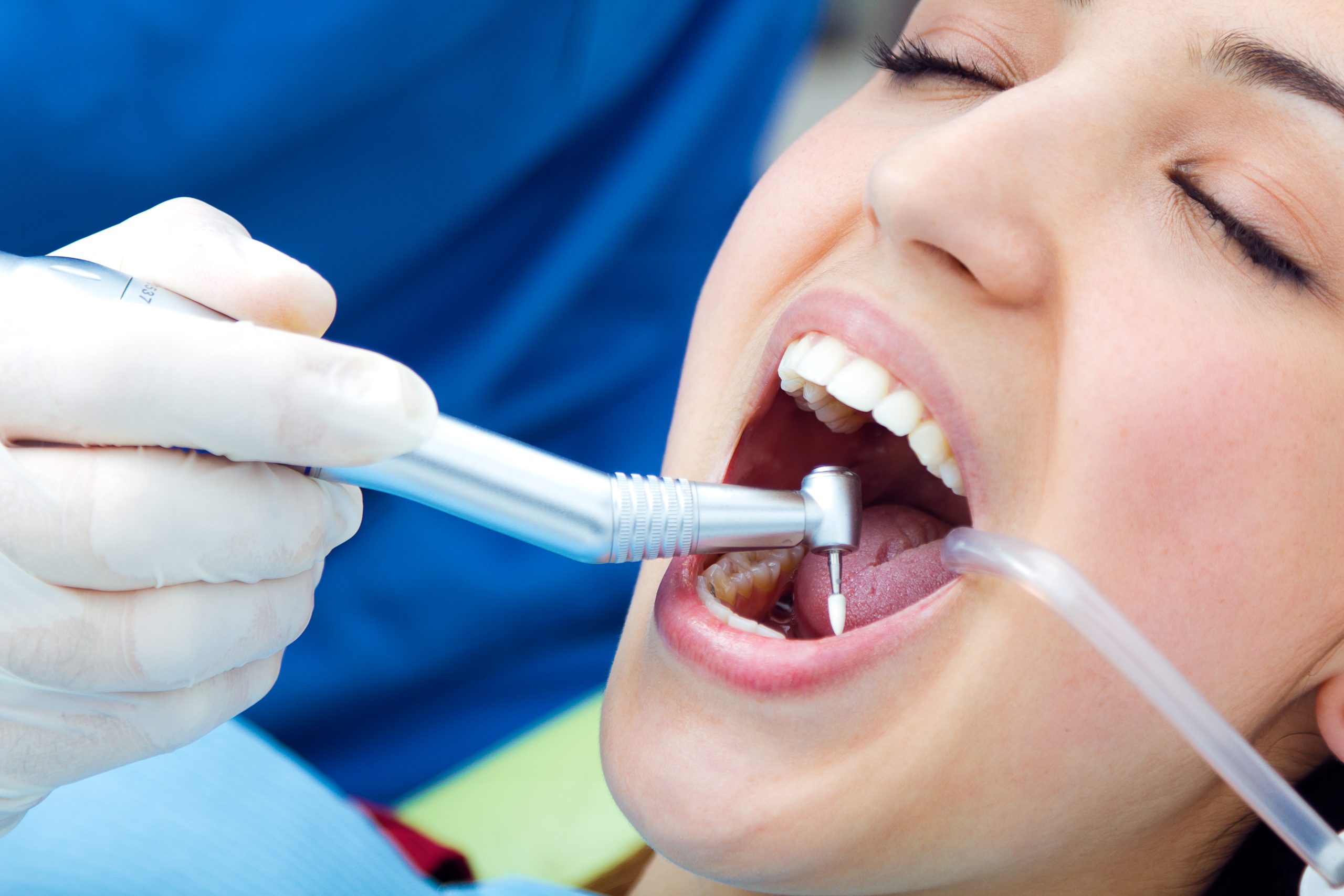 Dental Filling at Pure Smile Dental Clinic in Dubai - UAE