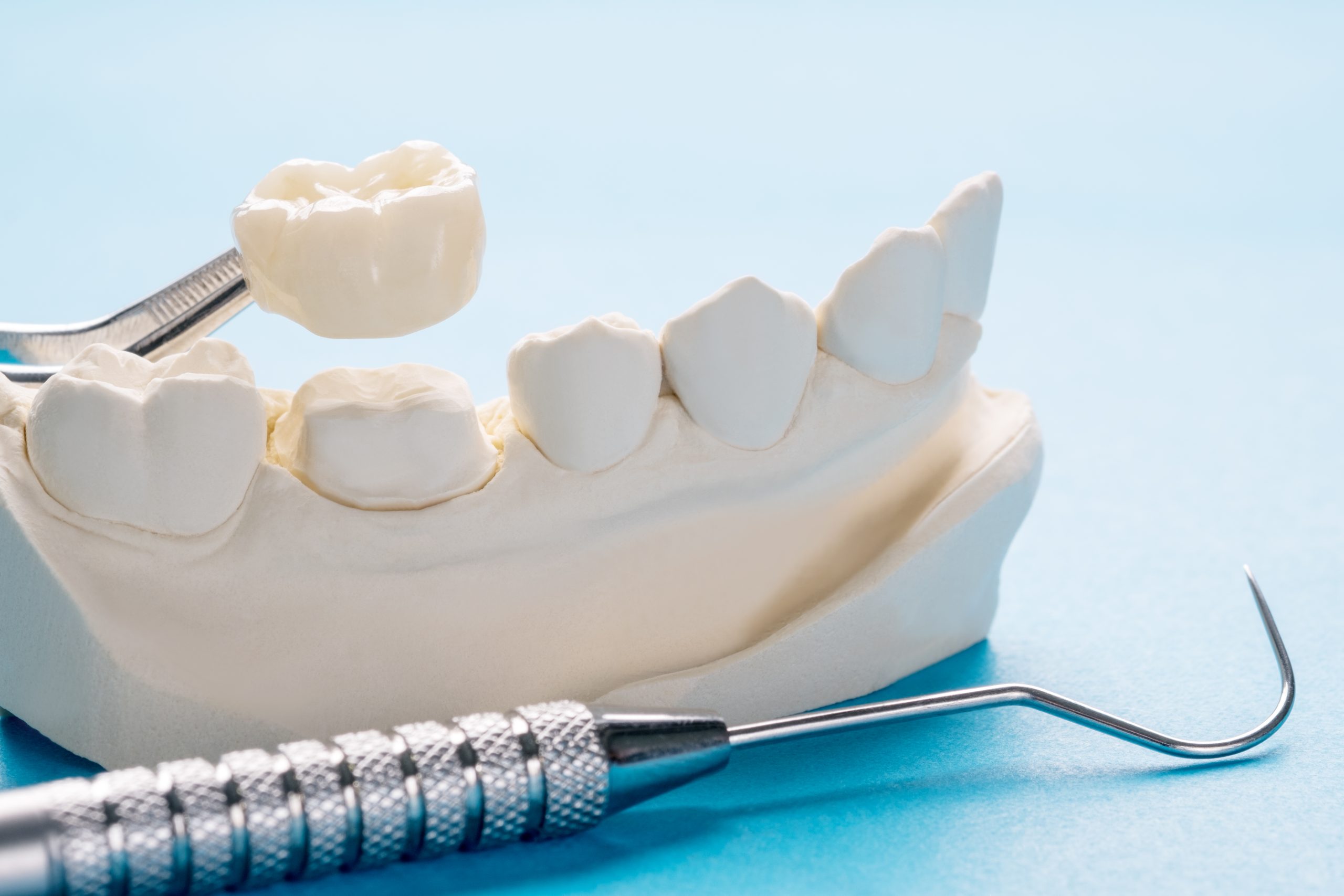 Dental Crown at Pure Smile Dental Clinic in Dubai - UAE