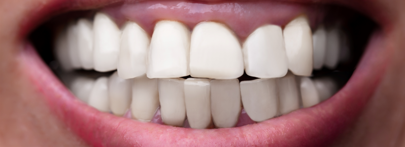 Teeth Cleaning in Dubai - After (1)