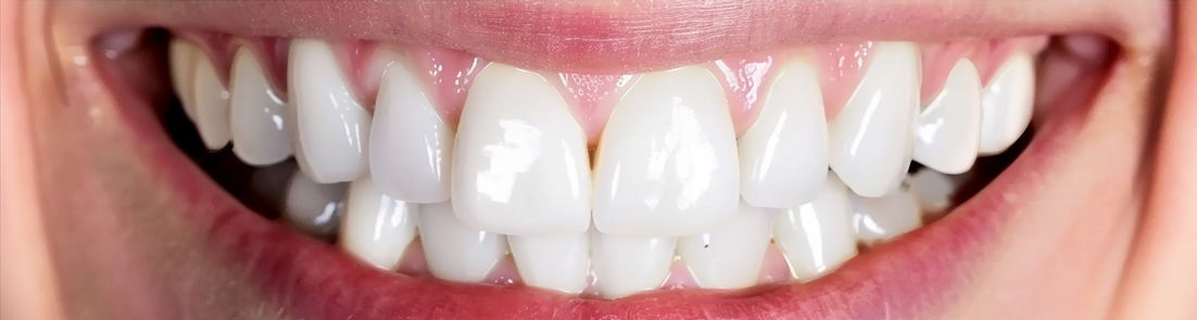 Teeth Cleaning in Dubai - After (3)