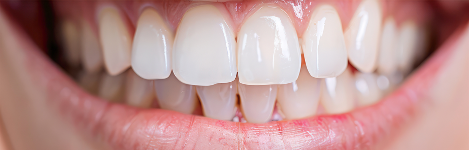 Teeth Whitening - After (2)