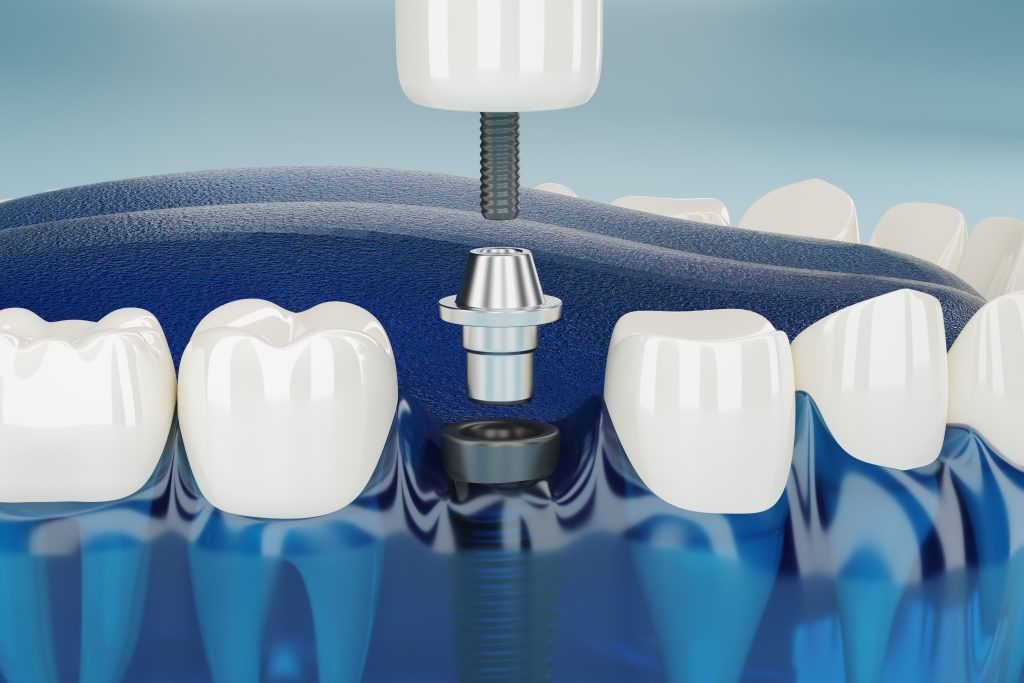 Best dental implants in Dubai UAE | Pure smile dental clinic 2025