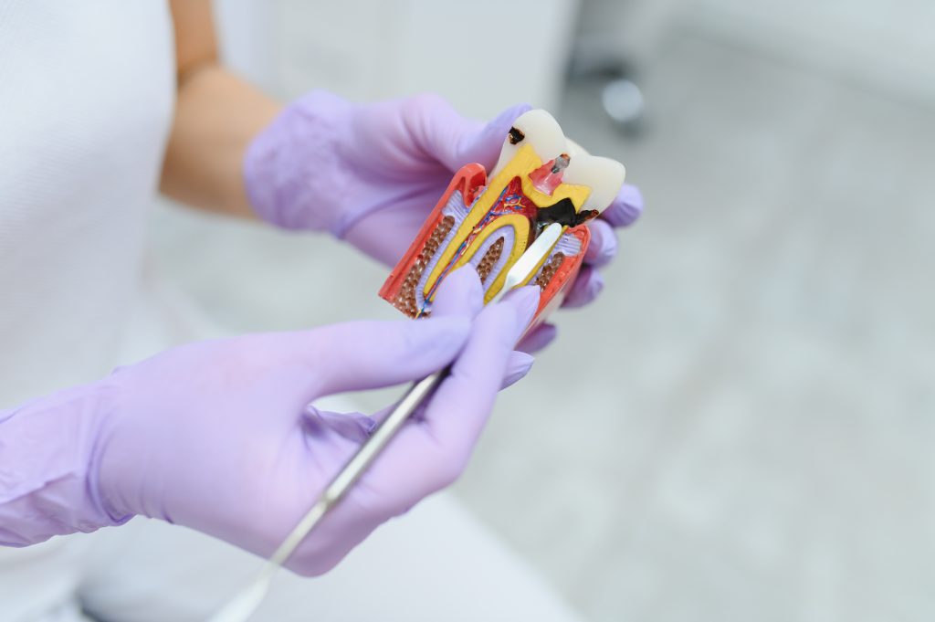 root canal treatment