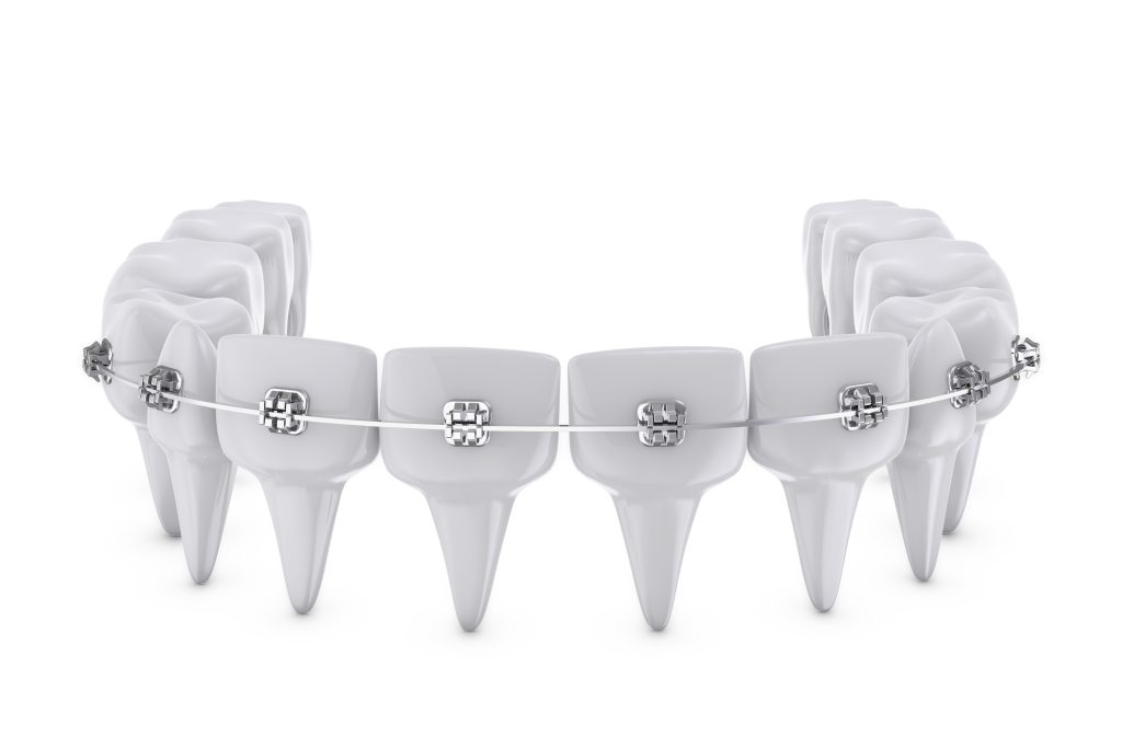 dental braces in dubai, uae at pure smile dental clinic