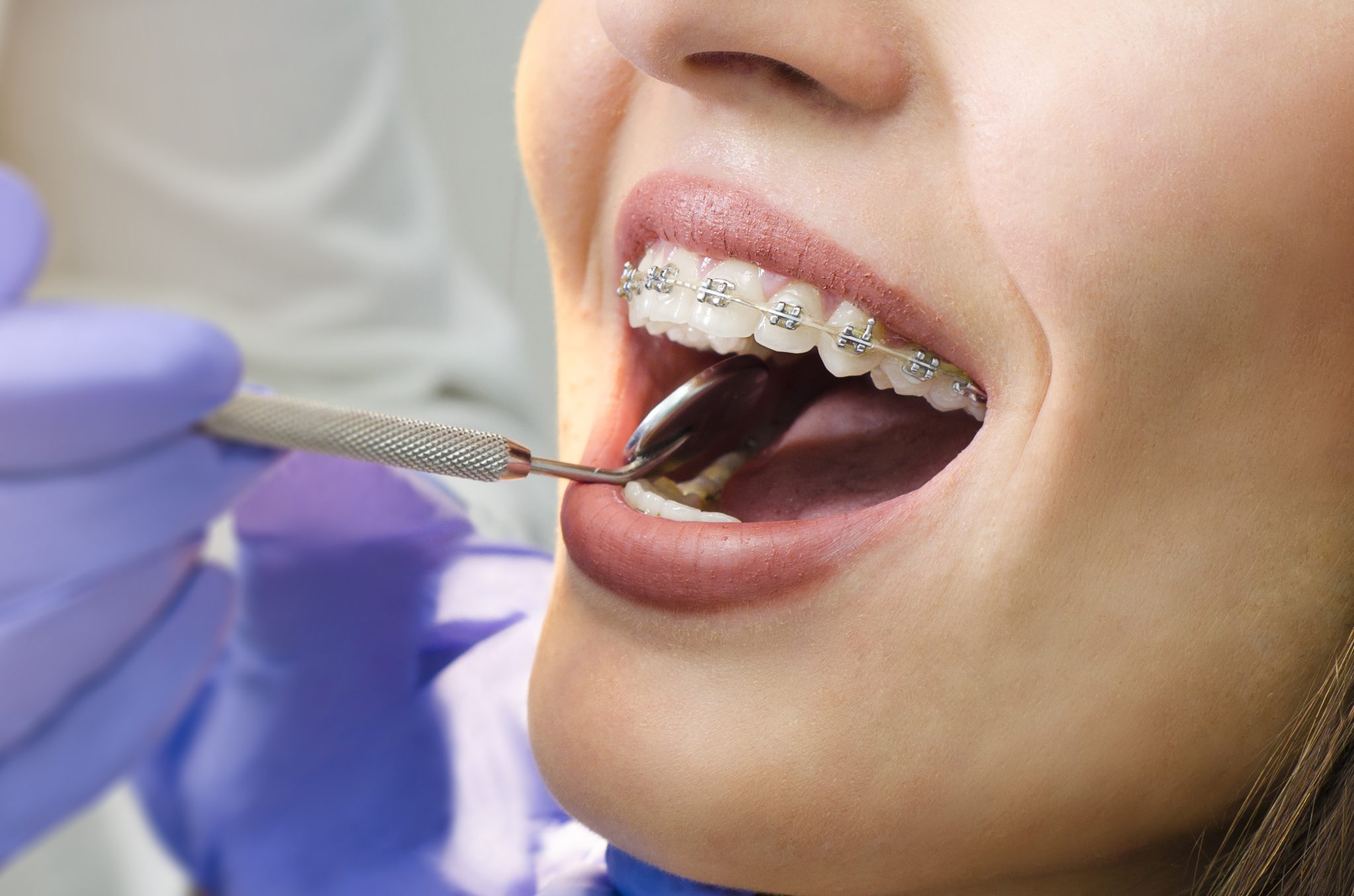 Dental Braces & Clear Aligners in Dubai | Pure Smile Clinic